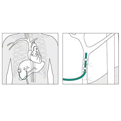 Placement of the Celsite® Arterial-Product Picture Enlargement CW